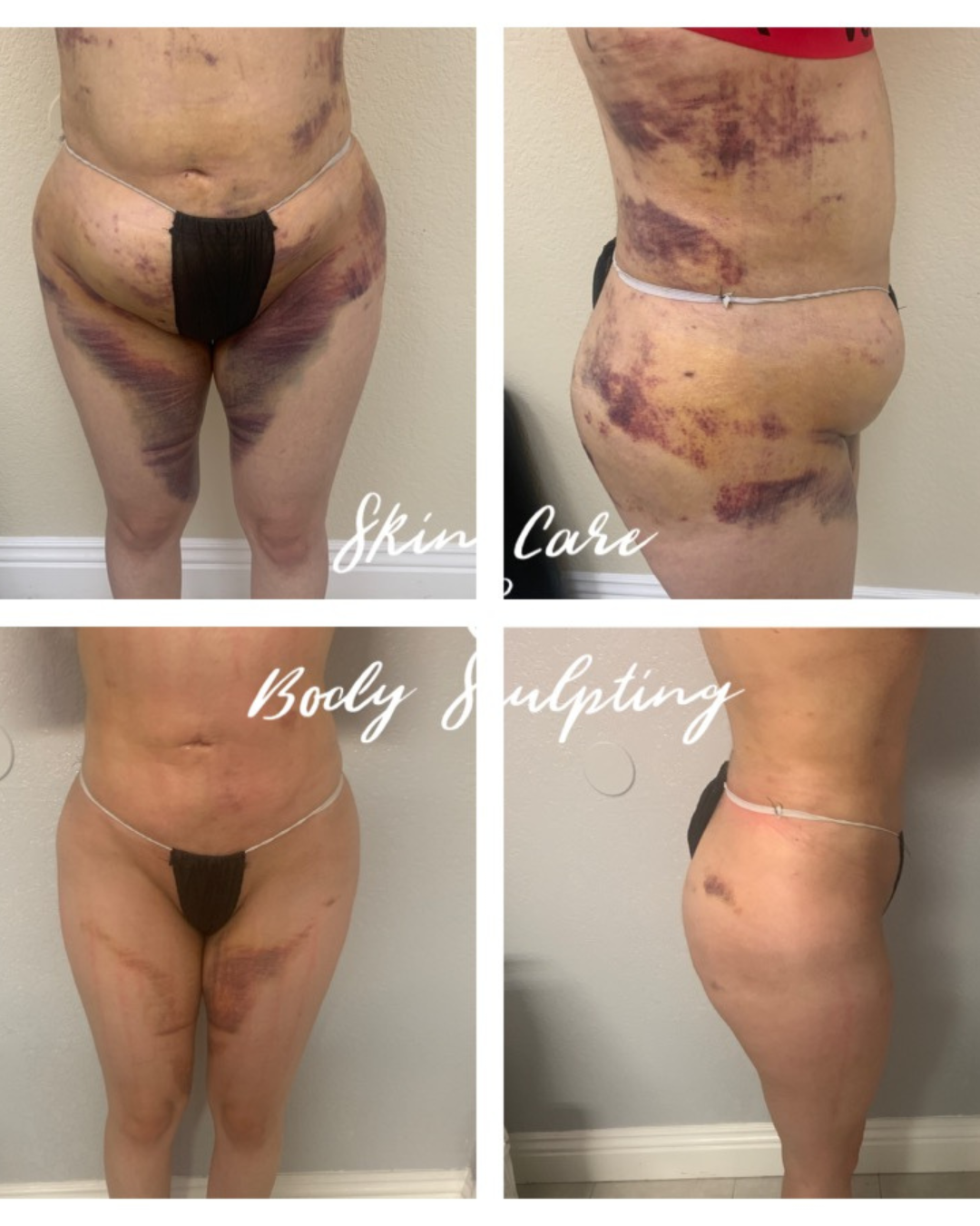 12 Sessions of Post-Op Treatments